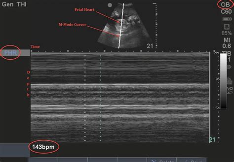 Fetal Heart Rate Ultrasound Images Unfortunately An Abnormal Fetal