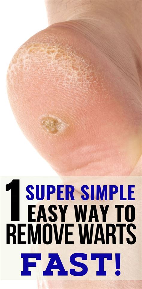 The Easiest Way To Get Rid Of Warts Naturally In 2020 Home Remedies