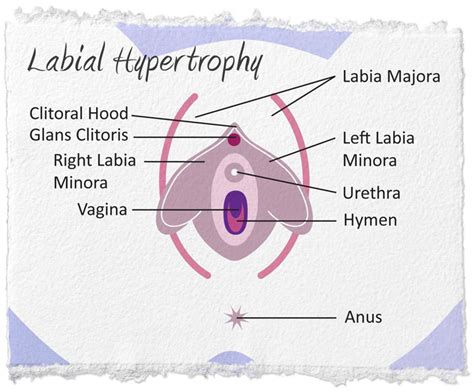 Labial Hypertrophy