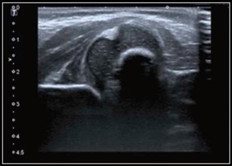 Case Of The Month January 2021 Ultrasound Of An Infant Hip After