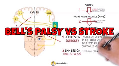 Bells Palsy Vs Stroke Facial Nerve Anatomy Facial Palsy