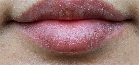 5 Simple And Natural Home Remedies To Heal Chapped Lips