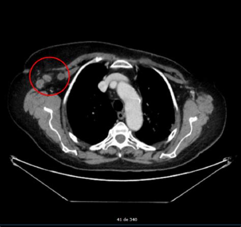 Contralateral Axillary Metastasis Is Surgical Treatment