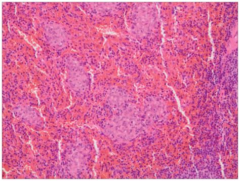 Isolated Sarcoidosis Of Accessory Spleen In The Greater Omentum A Case