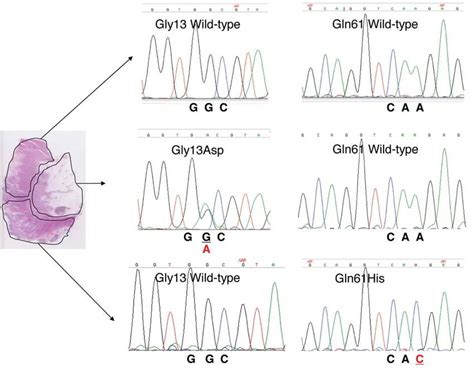 Direct Sequencing Of The Kras Gene Exons And From Dna Extracted