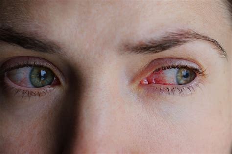 Pink Eye Vs Allergies Causes Symptoms And Treatment Stuffy Nose Remedy Treating Sinus