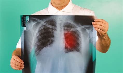 Lung Cancer How Do You Know If Your Cough Is A Symptom Of The Disease