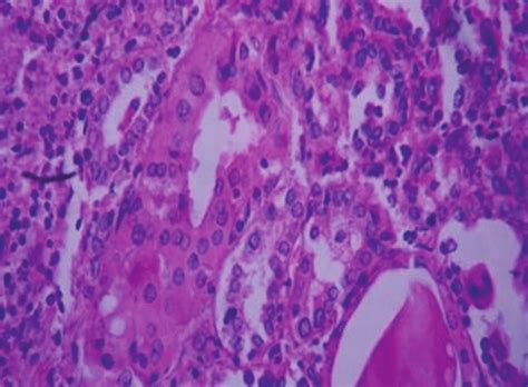 A Case Of Hashimoto Thyroiditis—clinical Gross And Histopathological