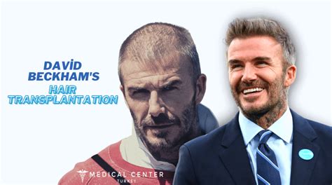 David Beckhams Hair Transplantation Mct