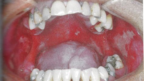 Multiple Ulcers In Mouth Ulcer Choices