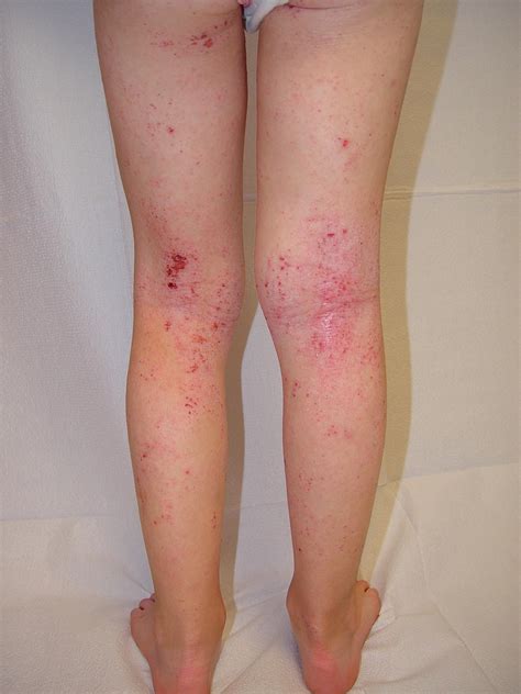 Eczema Symptoms And Causes National Eczema Association