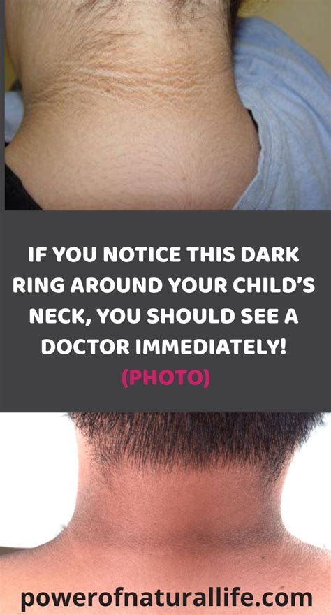 If You Notice This Dark Ring Around Your Childs Neck You Should See A