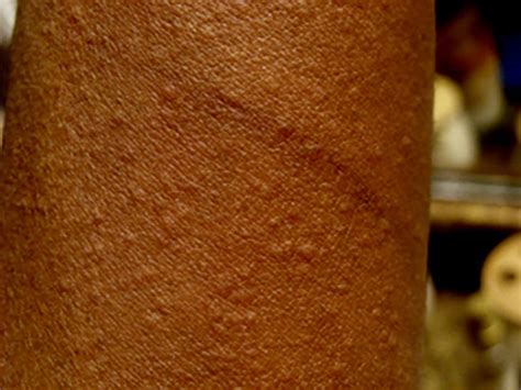 Hives Urticaria On Black Skin Pictures Treatments And Causes