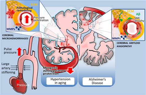 Cerebral Microhemorrhages Mechanisms Consequences And Prevention