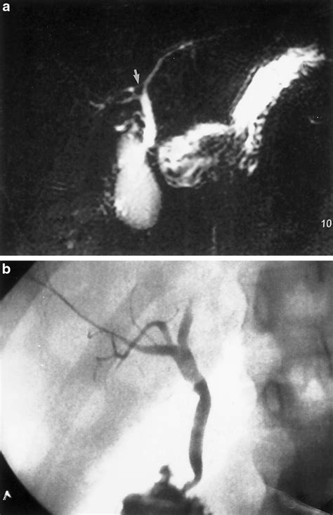 the utility of mrcp in preoperative mapping of biliary anatomy in adult‐to‐adult living related