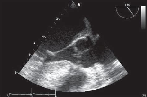 Transesophageal Echocardiogram Shows Linear Mobile Densities On The