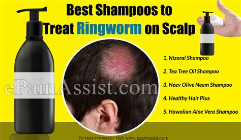 Best Shampoo To Treat Ringworm On Scalp