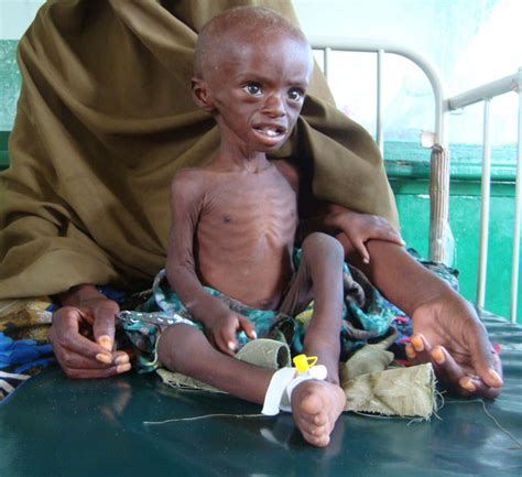 Kwashiorkor can be diagnosed based on physical appearance and knowledge about the person's diet and care. PERSONAS DESESPERADAS: SOMALIA. NIÑOS HAMBRIENTOS....