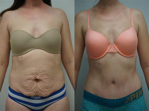 Pictures Of Tummy Tuck Results Cosmetic Surgery Tips