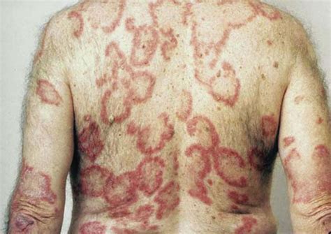 Acute Eczema Pictures Photos