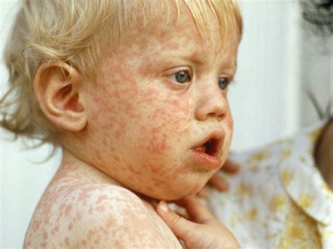 Childhood Rashes Skin Conditions And Infections Photos Rash On Face