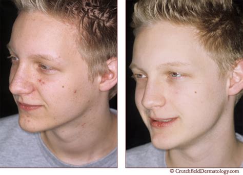 Acne Before And After Acne 0615