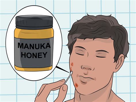 The infection happens at the hair follicles hence these ingrown hairs result from tweezing, shaving and electrolysis which causes the hairs to how to treat infected ingrown hair? 3 Modi per Trattare un Pelo Incarnito Infetto - wikiHow