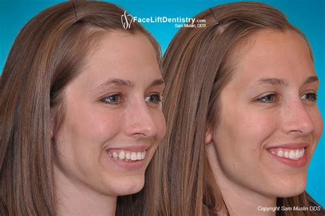 Jaw Surgery Alternative Non Invasive Facelift Dentistry