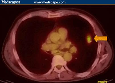 CT Scans And The Conundrum Of The Solitary Pulmonary Nodule