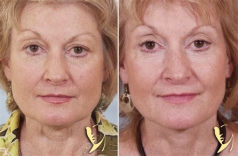 Skin Resurfacing Before And After Gallery Atlanta Ga Dr Burke