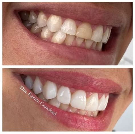 Dental Shocking Transformation 54 Nice Teeth Dental Healthy Teeth