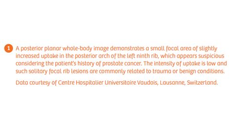 Differentiation Of A Rib Benign Lesion From A Metastasis Using Xspect Quant