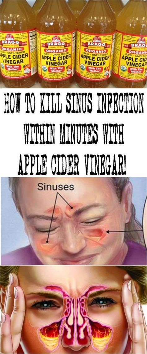 How To Treat Sinus Infection Within Minutes With Apple Cider Vinegar