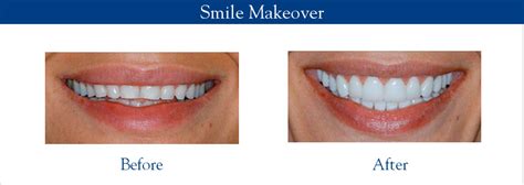 Smile Makeover Carroll Dentistry