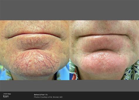 Ipl Photofacial Houston Skin Revitalization Pearland Laser