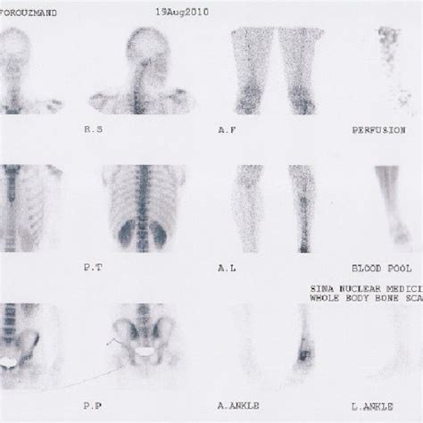 Preoperative Whole Body Scan Of A Previous Pilon Fracture With Signs Of