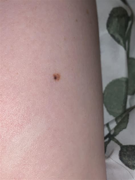 Ive Noticed A Black Spot Appear On My Mole Should I Be Worried R