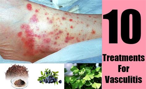 10 Treatments For Vasculitis Natural Treatments Vasculitis