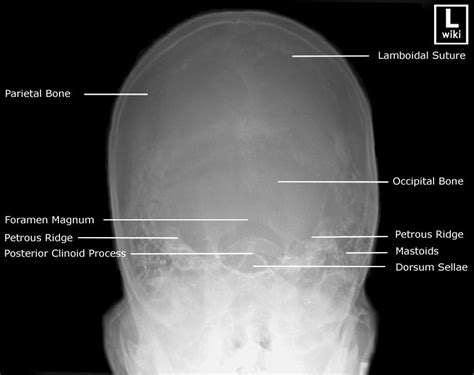 Skull Townes Radiology Schools Radiology Student Tech School