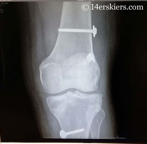 Two New Screws In My Knee From This Acl Revision Acl Knee Acl