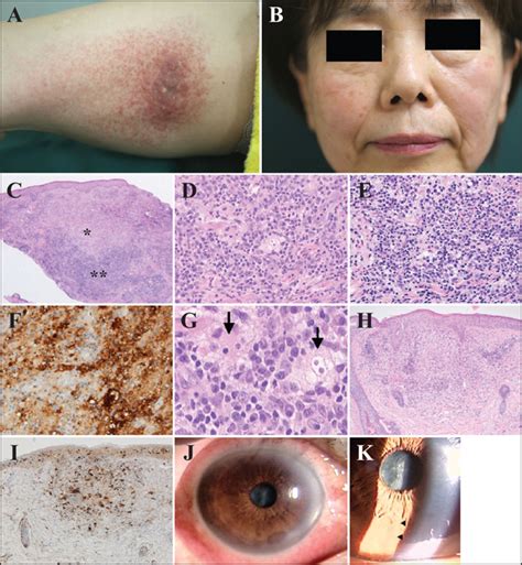 Jle European Journal Of Dermatology Cutaneous Rosai Dorfman Disease