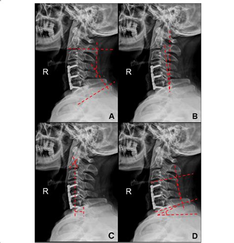 Measurement Of Parameters A C2 7 Lordosis B K Line Tilt C C2 7 Sva