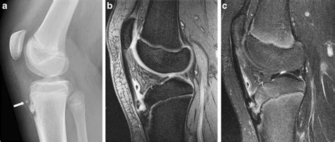 Osgoodschlatter Disease In A 13 Year Old Male Soccer Player With Knee