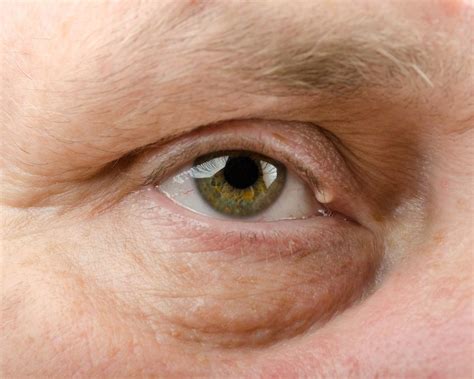 O Que é Um Cisto De Gordura No Olho Área Oftalmológica Avanzada