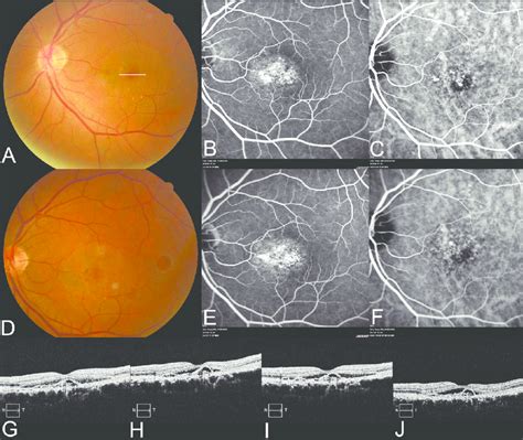 Fundus Photography Fluorescein Angiography Fa Indocyanine Green