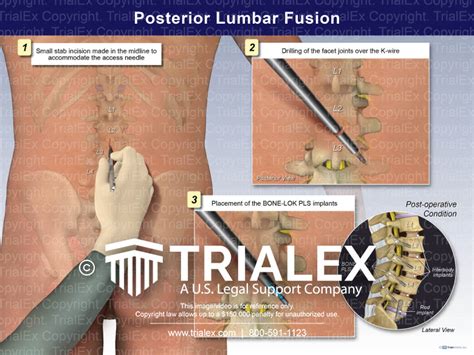 Posterior Lumbar Fusion Trial Exhibits Inc