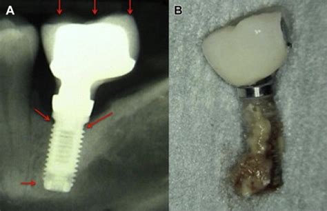 Peri Implant Diseases Pocket Dentistry