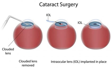 What Types Of Cataract Surgery Are There Lowcountry Eye Specialists Ophthalmologists