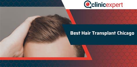 Best Hair Transplant Chicago Clinicexpert