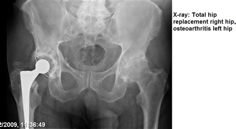 Osteoarthritis Juniorbones